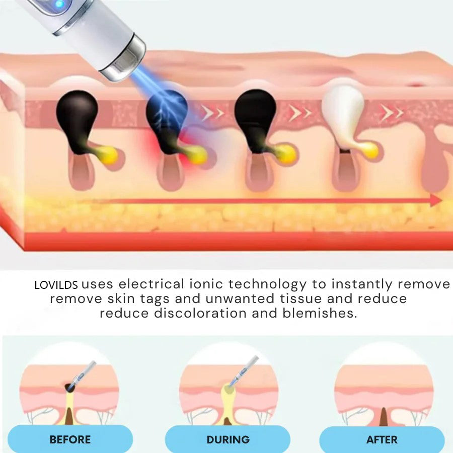 Buying Bazaar™ Non-Invasive Mole & Wart Removal Laser Pen – Safe, Painless, Portable