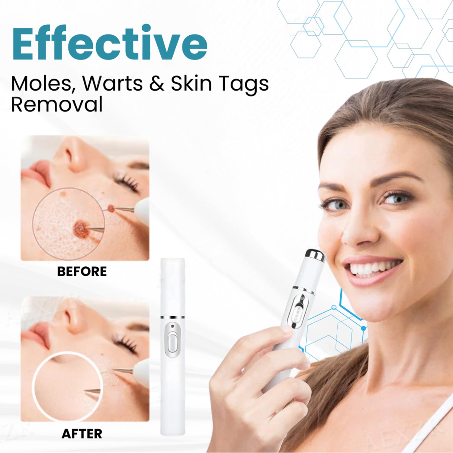 Buying Bazaar™ Non-Invasive Mole & Wart Removal Laser Pen – Safe, Painless, Portable