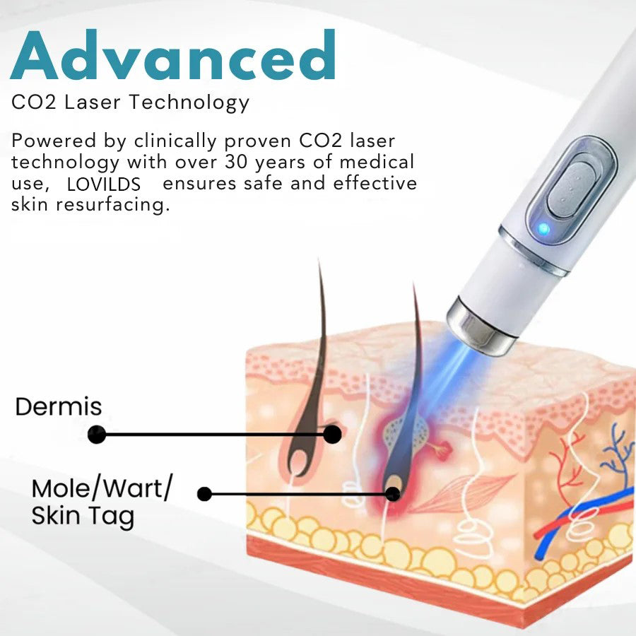 Buying Bazaar™ Non-Invasive Mole & Wart Removal Laser Pen – Safe, Painless, Portable