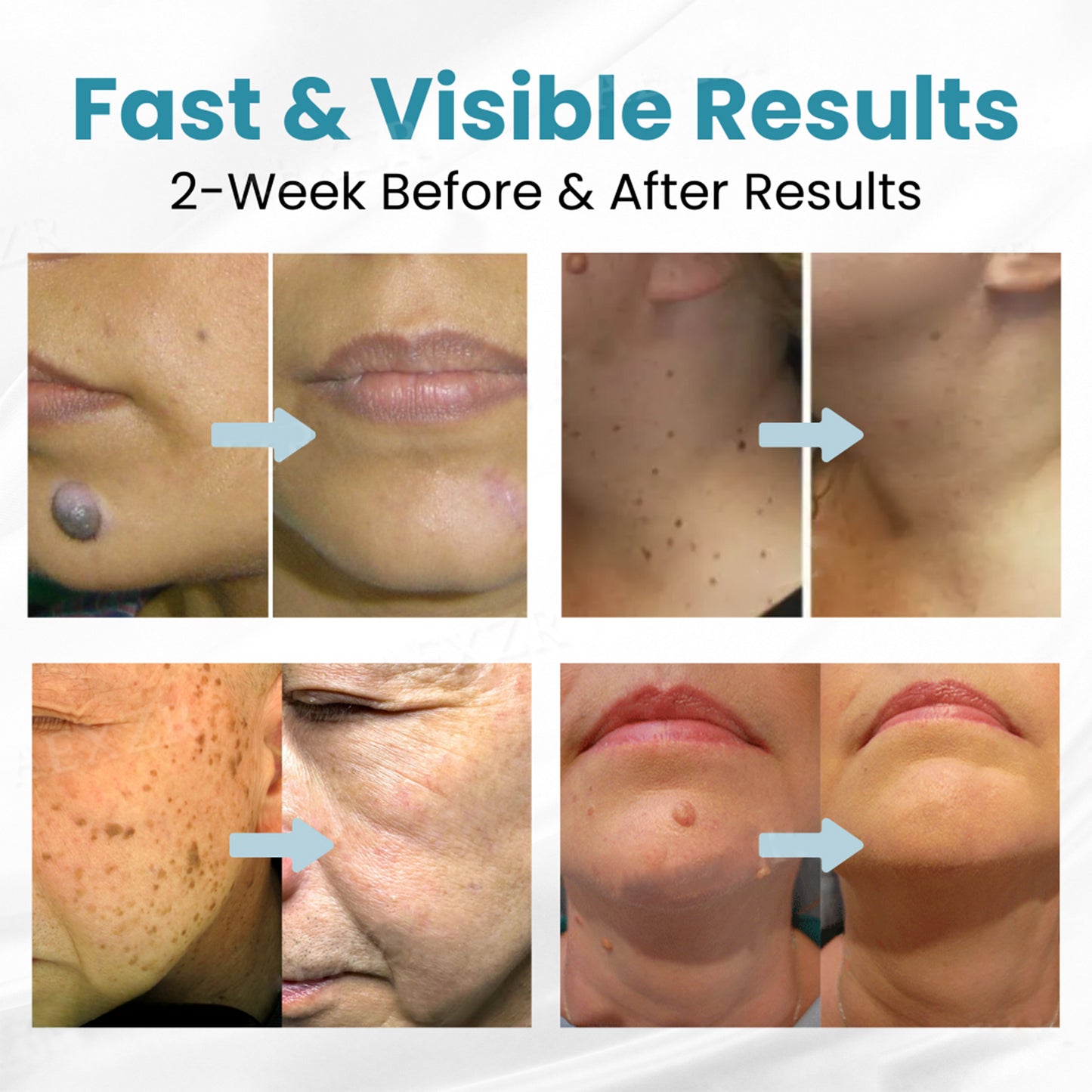 Buying Bazaar™ Non-Invasive Mole & Wart Removal Laser Pen – Safe, Painless, Portable